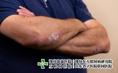 摄图网_506142425_特应皮炎症状皮肤细节纹理（企业商用）