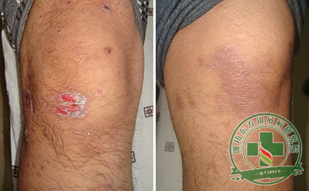 医生浅谈银屑病反复发作的根源