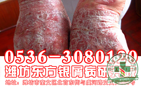 对于牛皮癣，我们要了解哪些知识？