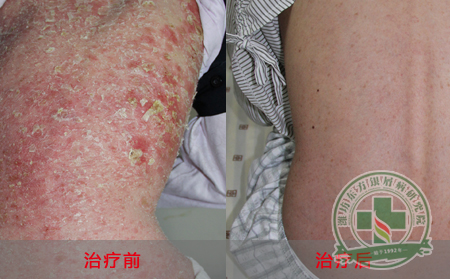 银屑病会给患者造成哪些发病危害？
