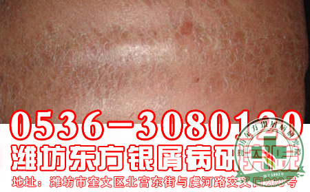 误解银屑病的传染的历史因素有什么？