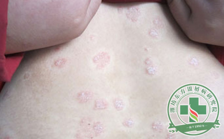 银屑病患者在秋季怎样护理？