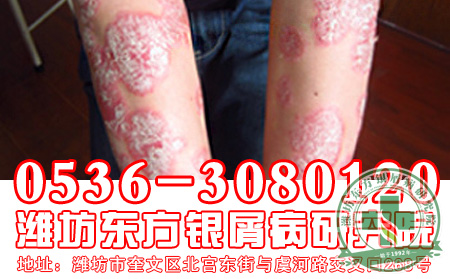 银屑病发病一般与什么原因有关系？
