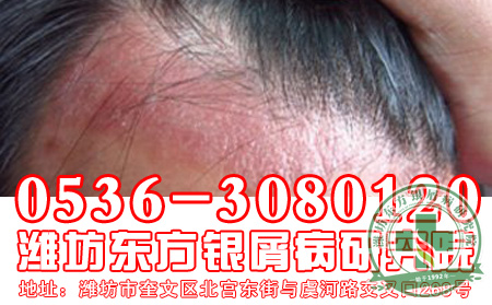 银屑病给你的伤害，你要怎样对待？