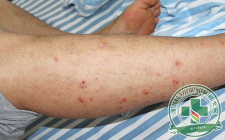 了解牛皮癣治疗切勿乱治
