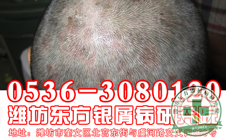 头部银屑病初期有哪些症状表现？