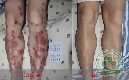 脓疱型银屑病如何护理