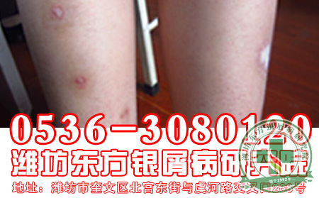 寻常型银屑病皮肤症状