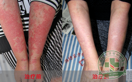 银屑病治疗要注意的问题是什么？