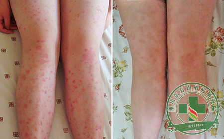 女性牛皮癣患者治疗时服药要注意哪些问题？