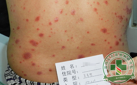 烟酒对银屑病患者有哪些危害