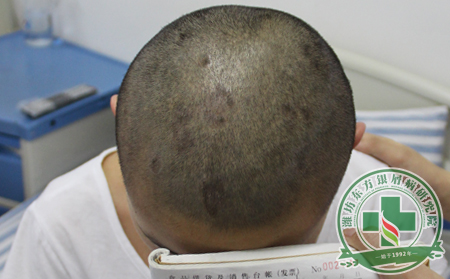 治疗小儿银屑病家长需要注意什么？