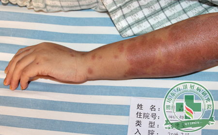 银屑病症状