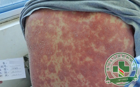 NEJM：Brodalumab治疗中度至重度银屑病，效果良可以