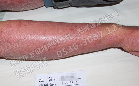 济南银屑病患者恶化为红皮型怎么办