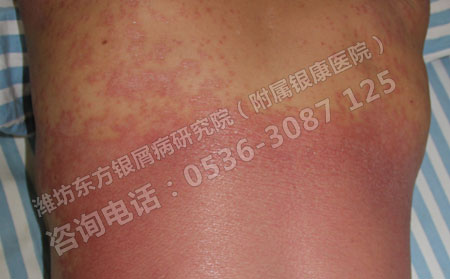红皮型牛皮癣的主要诱发因素有哪些