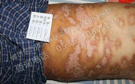 男性银屑病患者如何注意身体养生