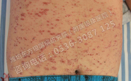 治可以银屑病，患者要做哪些准备呢
