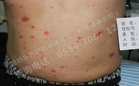 济南点滴状银屑病怎么能治可以?