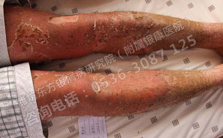 济南哪家医院治疗银屑病良实力