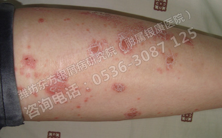 感冒对牛皮癣患者有影响吗?