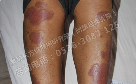 银屑病可以有效治可以吗