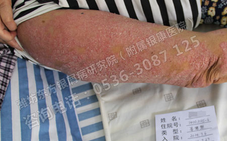 子女遗传父母银屑病的几率大不大
