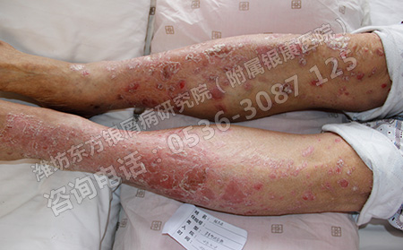患上银屑病后饮食上要如何调节可以？