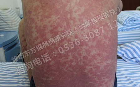 背部有牛皮癣怎么护理可以呢
