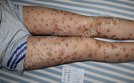 济南女性银屑病患者怎么治疗效果可以