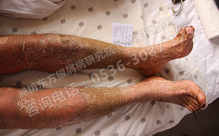 济南哪个医院治疗牛皮癣信誉高