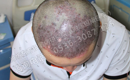怎样控制头部银屑病蔓延恶化