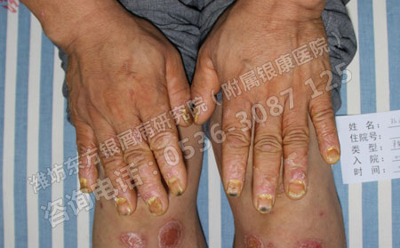 牛皮癣患者如何通过饮食吃出健康