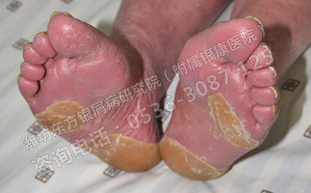 严重的红皮型牛皮癣是否该放弃治疗呢