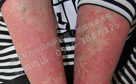 女性患银屑病会有哪些危害