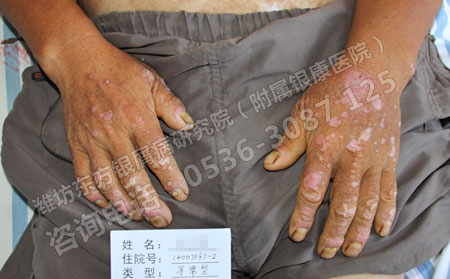 手部银屑病患者的日常护理方法是什么