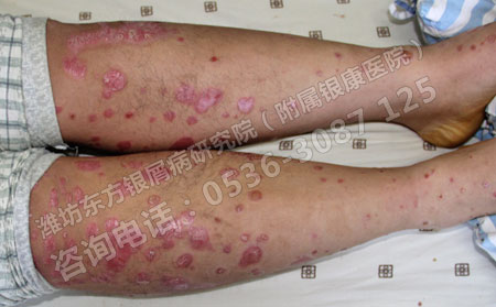 治顽固银屑病规范性很关键