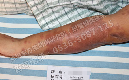 皮肤上大面积牛皮癣还能治可以吗会留下疤痕吗