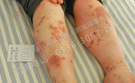 治疗银屑病如何取得良可以的成果呢