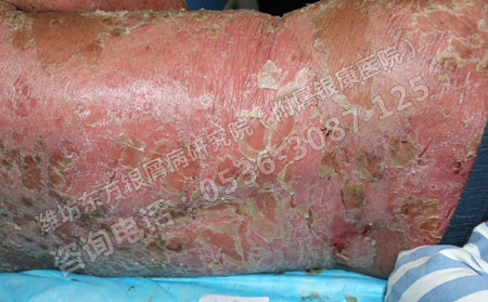 银屑病如何巧妙治疗获得可以的效果