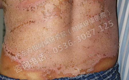 一般治银屑病多久可以出院时间怎么缩短