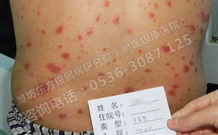 怎么避免寻常型银屑病病情恶化呢