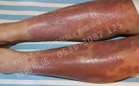 济南看银屑病治疗的费用多少
