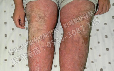 济南治疗银屑病的医院哪家排名可以