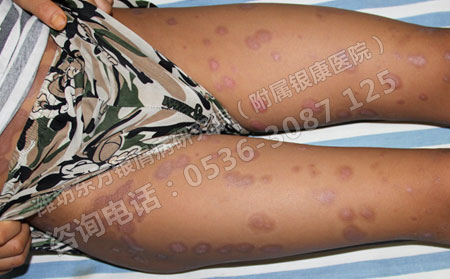 济南防治牛皮癣的方法有哪些呢?