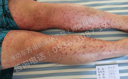 济南治疗银屑病的费用怎么降低