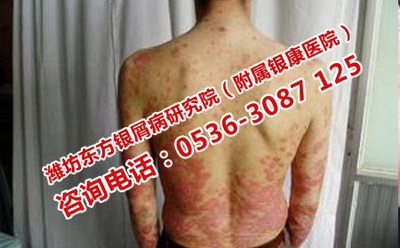 治疗银屑病的医院怎么去
