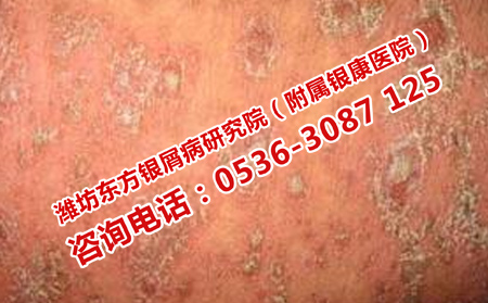治疗复发性牛皮癣
