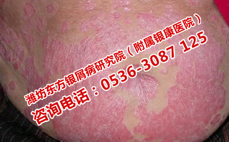 复发的牛皮癣怎么能治可以
