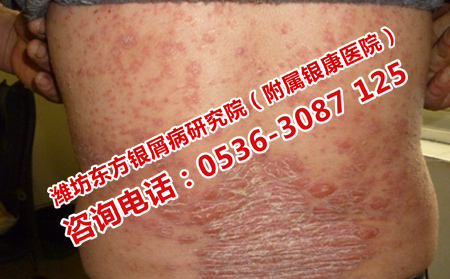 皮肤上寻常型牛皮癣治疗